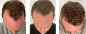 Finasterid Vorher Nachher Bilder